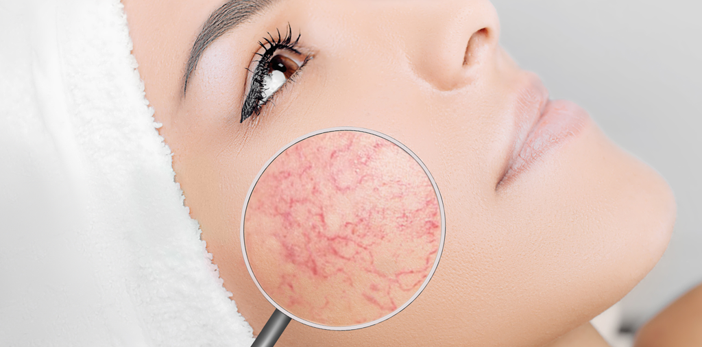 lesions-vasculaires-visage-1024x506